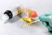 Kiểm tra Urine Glucose là gì?