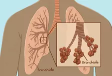 Bronchiles là gì?