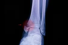 Medial Malleolus Fracture và phương pháp trị liệu Ankle hỏng