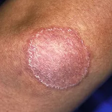 What Is Tinea Corporis?