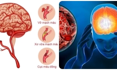 7 dấu hiệu cảnh báo cơn đột quỵ sắp xảy ra