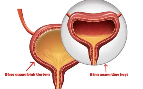 Mắc bàng quang tăng hoạt, không thể đi xe khách vì… tiểu nhiều