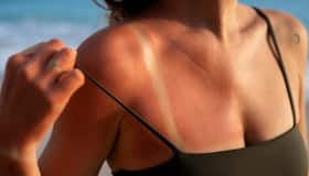 Bảo vệ da vào mùa hè: Cách hiệu quả để ngăn chặn Sunburn và Rash nhiệt