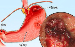 Cảnh giác với viêm loét dạ dày do vi khuẩn HP ở trẻ em