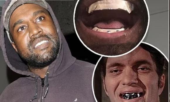 Kanye West 'chơi lớn', nhổ hết răng thật và thay thế bằng răng giả titan có giá hơn 20 tỷ nhưng liền bị phanh phui nợ tiền