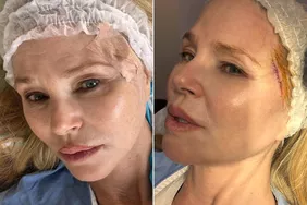 Christie Brinkley Reveals She Had Skin Cancer Removed from Her Face