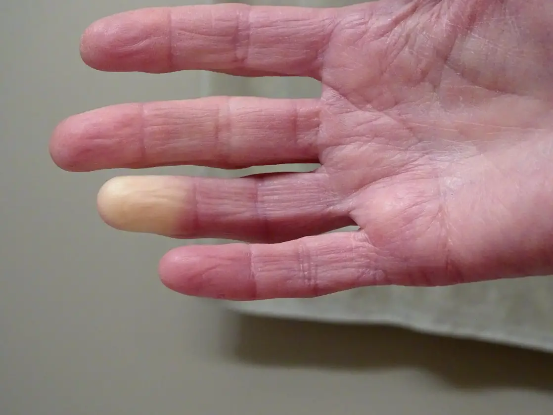 Vụ án lạnh đã được giải quyết: Bí ẩn của Raynaud được giải quyết bằng những phát hiện di truyền mới