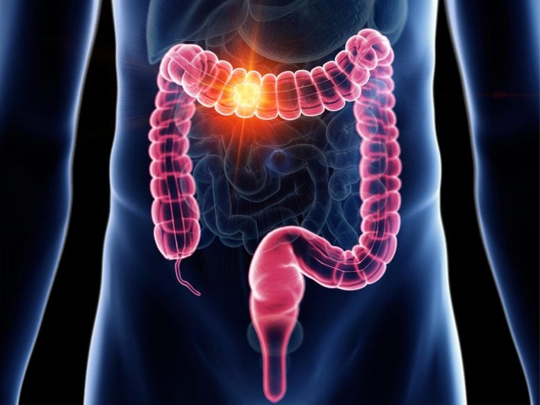 Decoding Efficacy: MIT Unveils the Surprising Truth About Colon Cancer Screenings