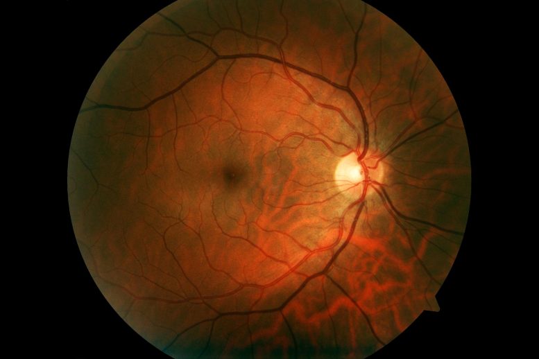 New Hope for Preventing Blindness: Unlocking the Microbial Mystery Behind Inherited Eye Diseases