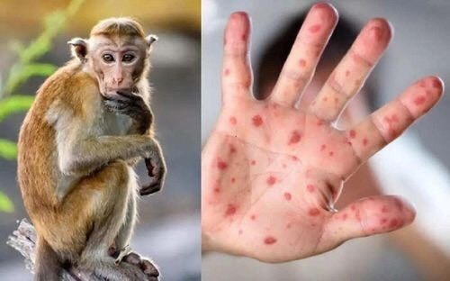 Long An Province reports first case of monkeypox