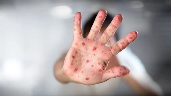 Ho Chi Minh City records first death of HIV-positive man with monkeypox