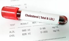 Trắc nghiệm để biết vì sao cholesterol cao