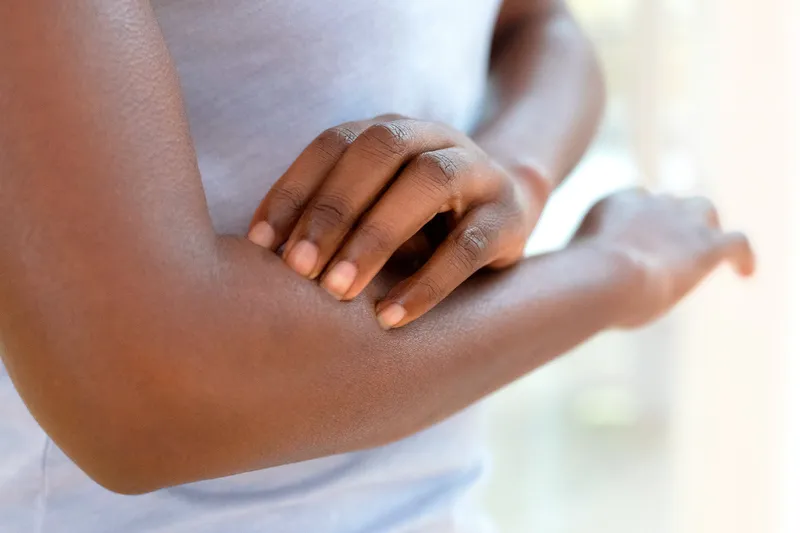 Breaking Stereotypes and Myths About Eczema and People of Color