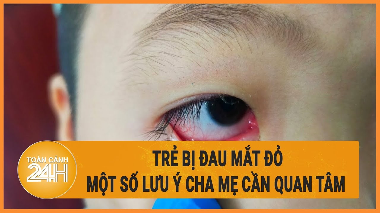 Trẻ bị đau mắt đỏ cần tuyệt đối tránh xa những thứ này, kẻo rước họa | Toàn cảnh 24h