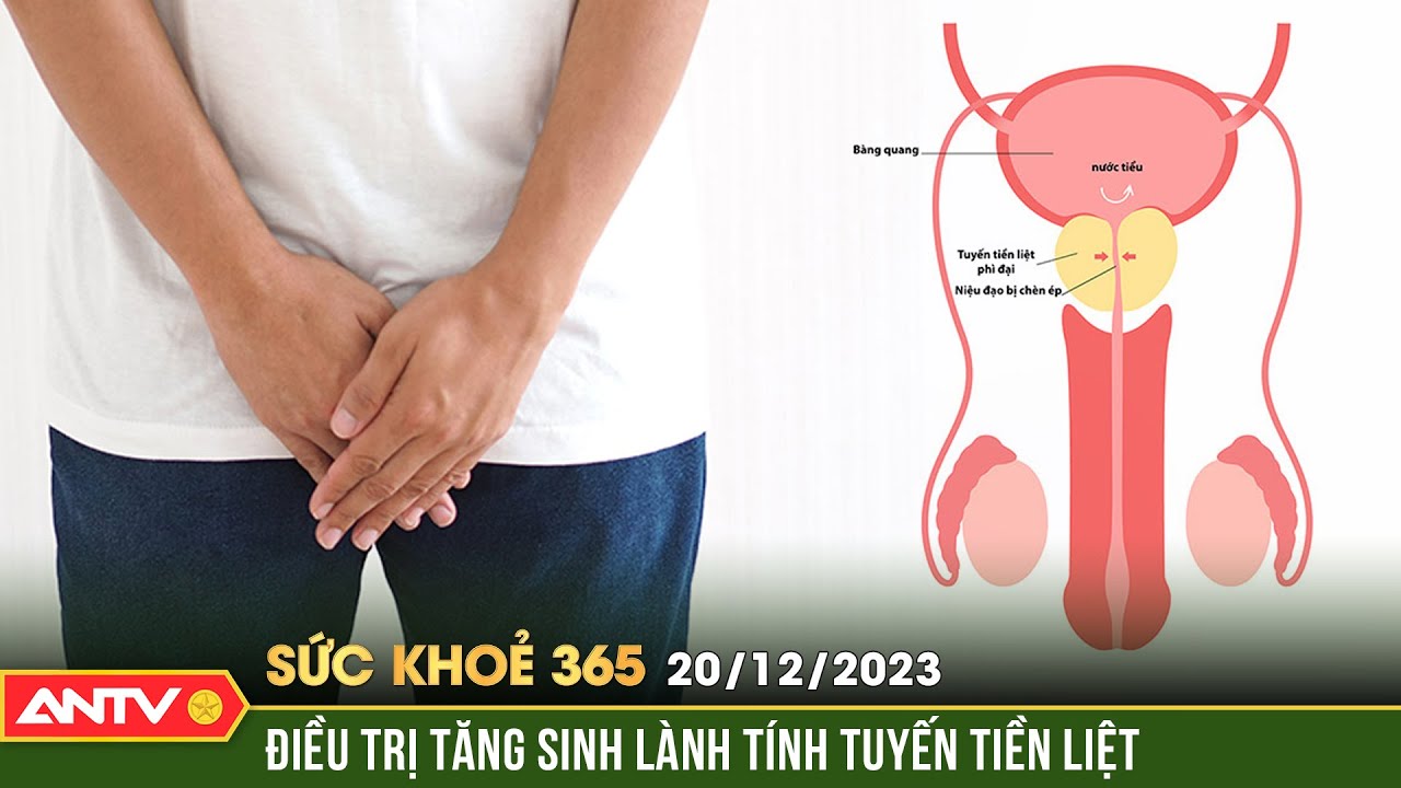 Tăng sinh lành tính tuyến tiền liệt: Nguyên nhân và phương pháp điều trị | Sức khỏe 365 | ANTV