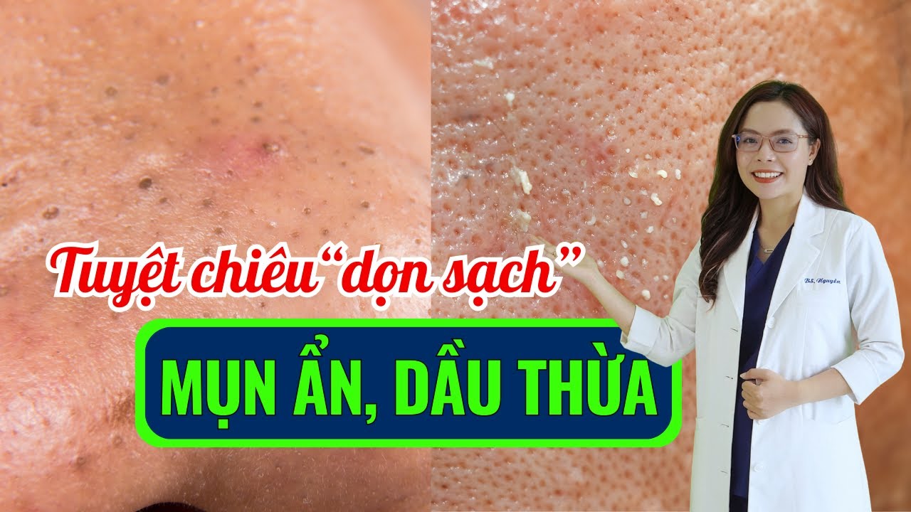 4 bí mật để dọn sạch được mụn đầu đen, mụn ẩn và kiềm dầu thừa - Bác sĩ Nguyên