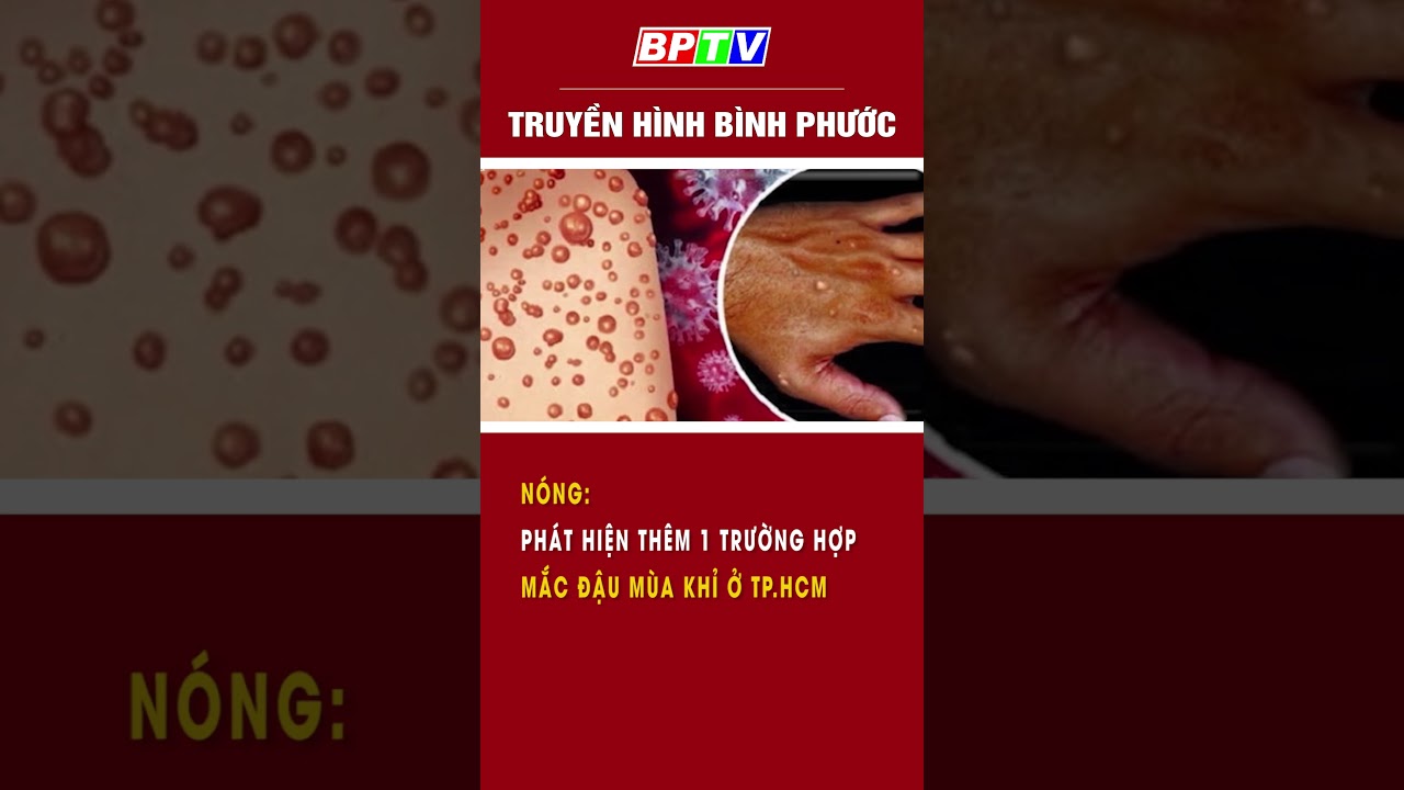 Nóng: Phát hiện thêm 1 trường hợp mắc đậu mùa khỉ ở TP.HCM #summerofshorts #mcvshorts  | BPTV