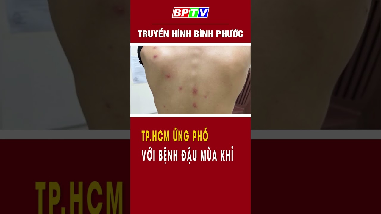 Thành phố Hồ Chí Minh ghi nhận 13 ca bệnh đậu mùa khỉ​ #summerofshorts #mcvshorts  | BPTV