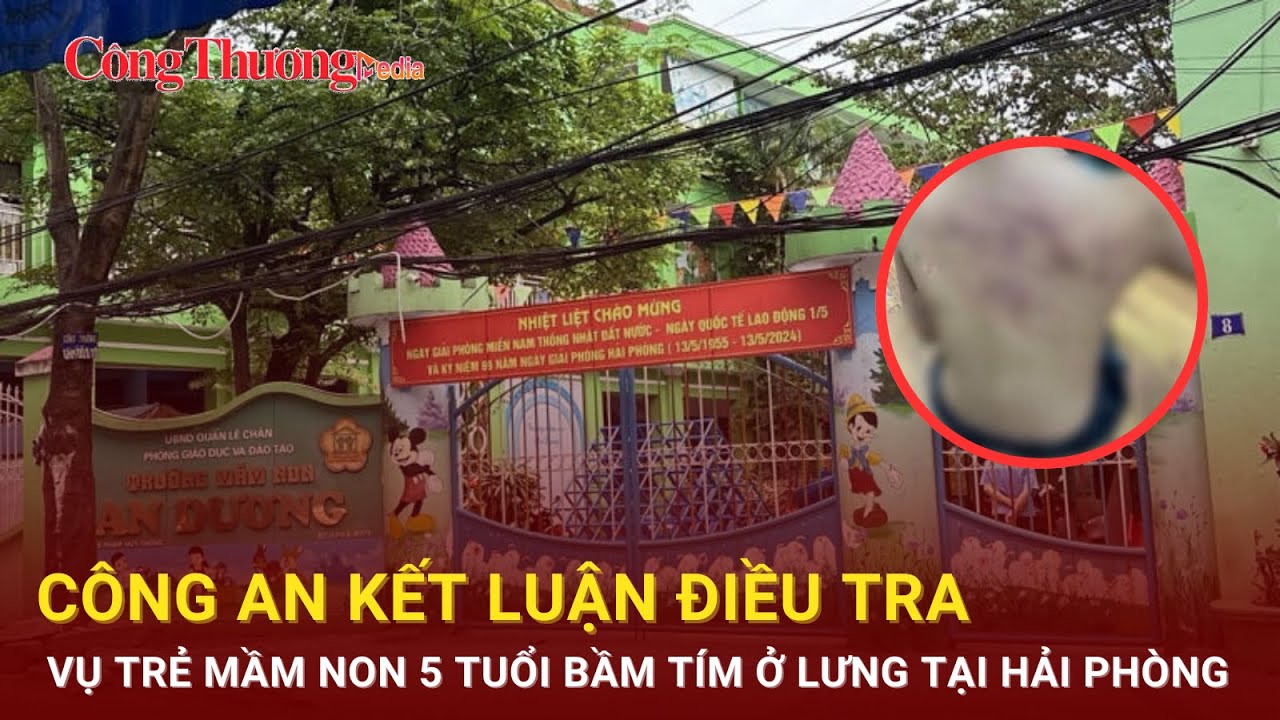 Công an kết luận điều tra vụ trẻ mầm non 5 tuổi bầm tím ở lưng tại Hải Phòng