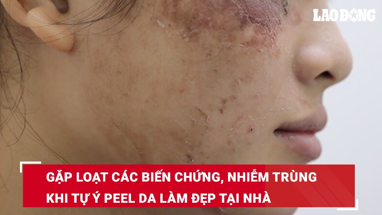 Gặp loạt các biến chứng, nhiễm trùng khi tự ý peel da làm đẹp tại nhà | Báo Lao Động