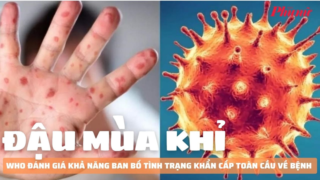 WHO đánh giá khả năng ban bố tình trạng khẩn cấp toàn cầu về bệnh đậu mùa khỉ | Báo Phụ Nữ