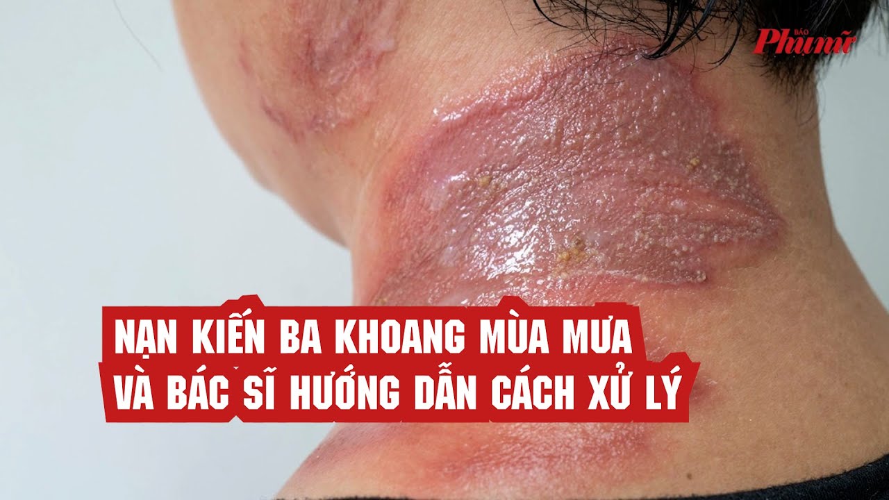 Nạn kiến ba khoang mùa mưa và bác sĩ hướng dẫn cách xử lý | Báo Phụ Nữ