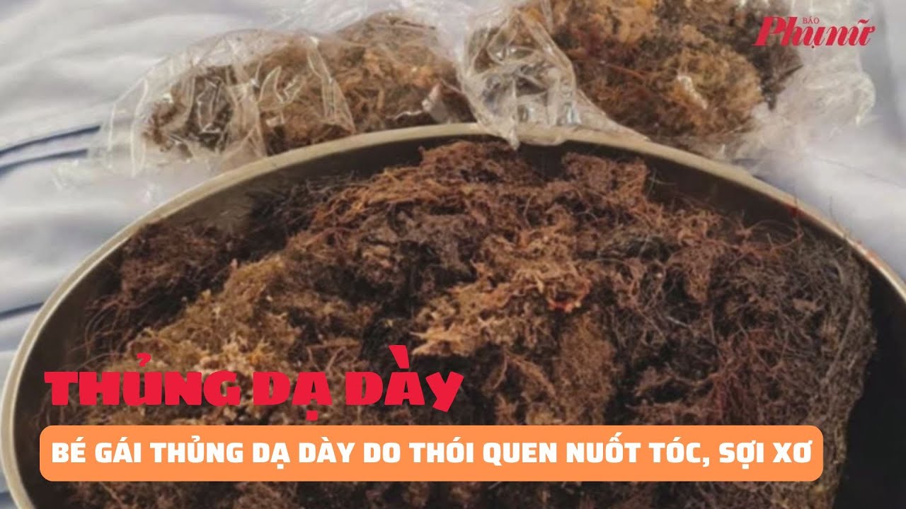 Bé gái 8 tuổi thủng dạ dày do thói quen nuốt tóc, sợi xơ | Báo Phụ Nữ