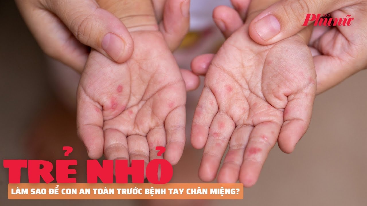 Làm sao để con an toàn trước bệnh tay chân miệng? | Báo Phụ Nữ