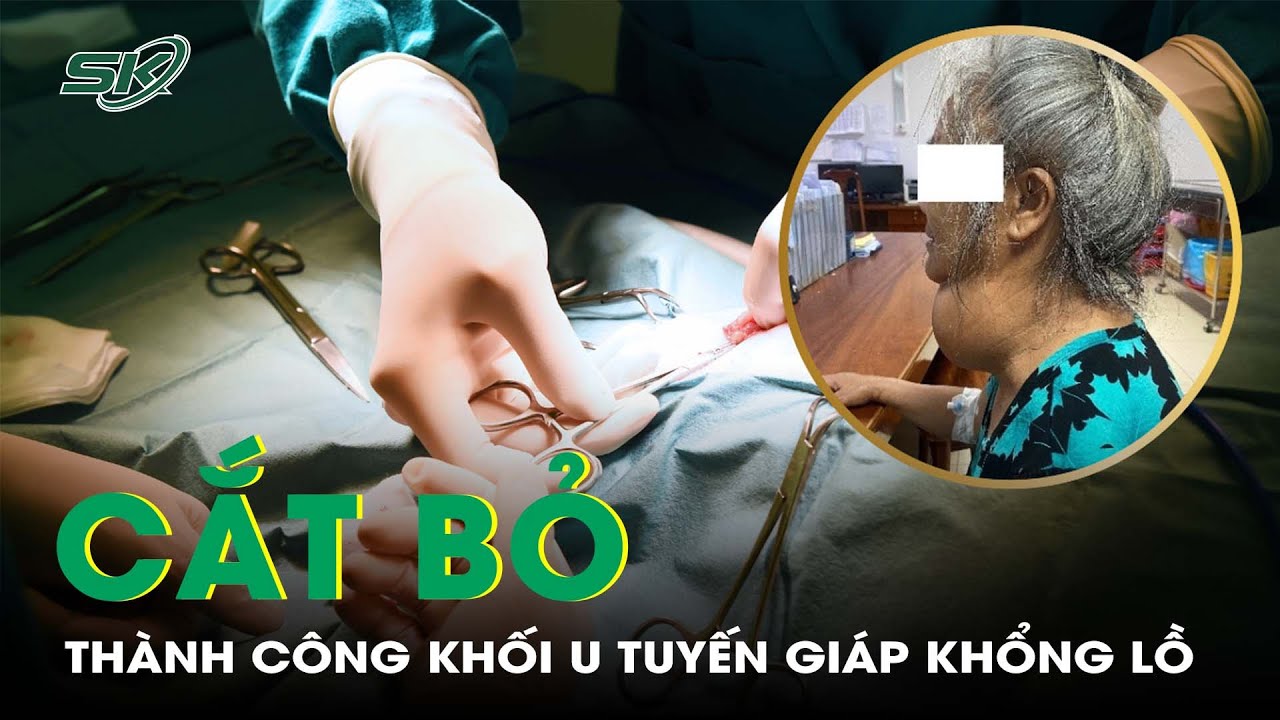 3 Giờ Phẫu Thuật Cắt Bỏ Thành Công Khối U Tuyến Giáp Kích Thước Khổng Lồ I SKĐS