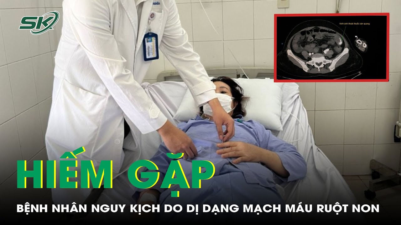 Hiếm Gặp: Bệnh Nhân Nguy Kịch Do Dị Dạng Mạch Máu Ruột Non | SKĐS