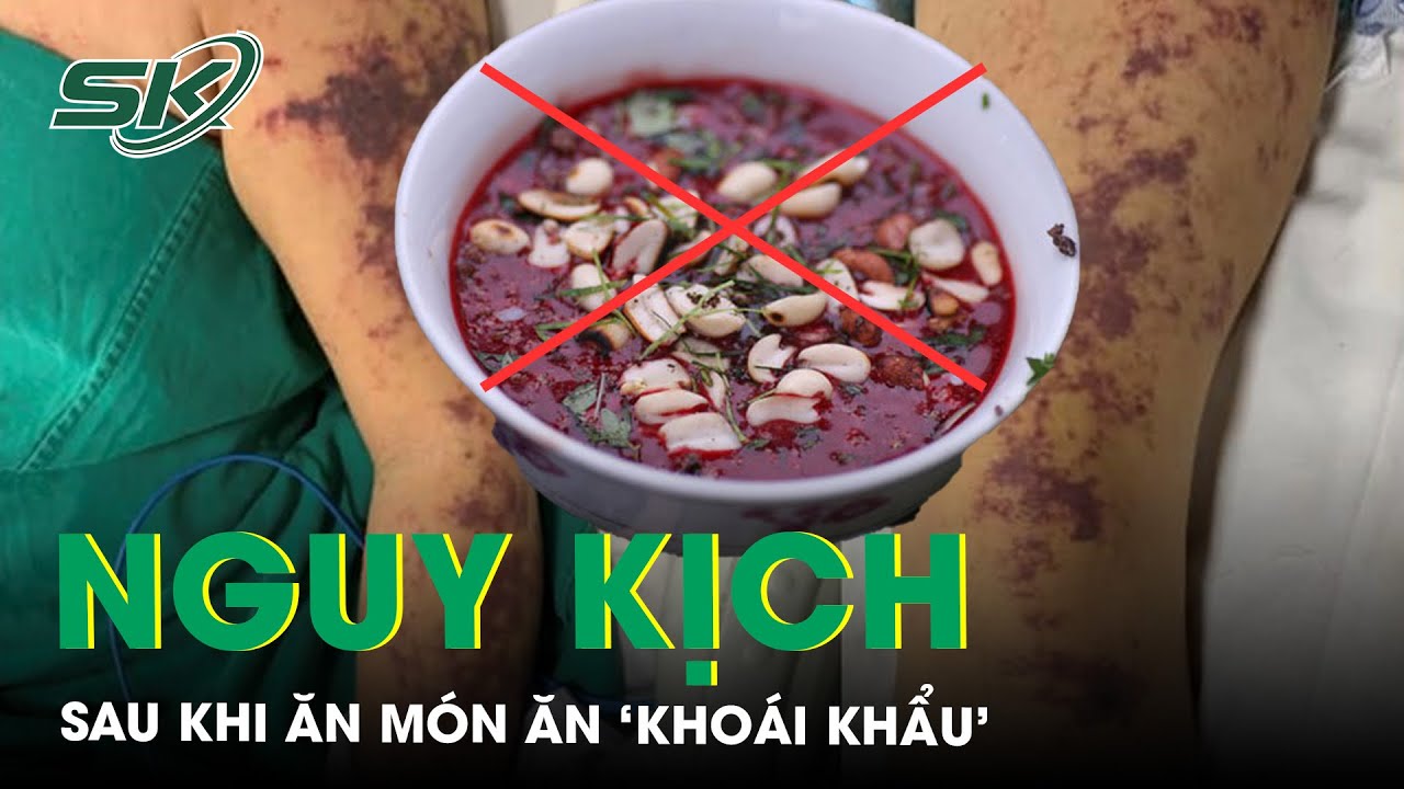 Nguy Kịch Sau Khi Ăn Món Ăn ‘Khoái Khẩu’ Nhiều Người Yêu Thích | SKĐS