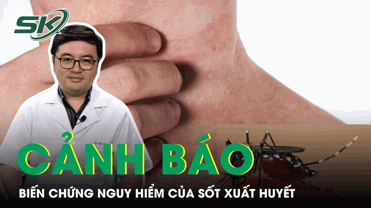 Cảnh Báo Những Biến Chứng Nguy Hiểm Khi Mắc Sốt Xuất Huyết | SKĐS