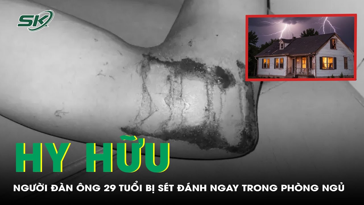 Hy Hữu: Người Đàn Ông 29 Tuổi Bị Sét Đánh Ngay Trong Phòng Ngủ | SKĐS