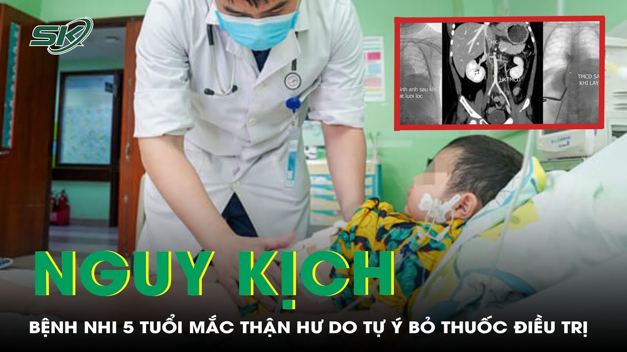 Bệnh Nhi 5 Tuổi Mắc Bệnh Thận Hư Nguy Kịch Do Bỏ Thuốc Điều Trị | SKĐS