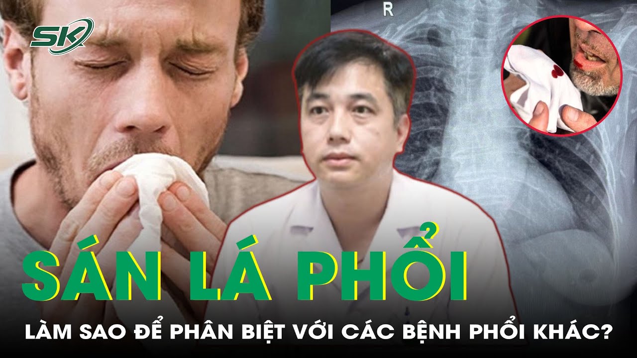 Làm sao để phân biệt sán lá phổi với các bệnh phổi khác? | SKĐS