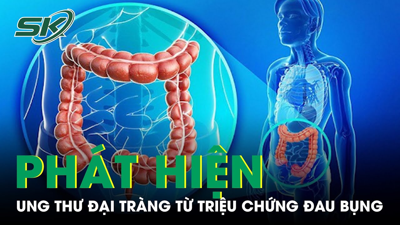 Phát Hiện Ung Thư Đại Tràng Sau Hai Tuần Đau Bụng | SKĐS