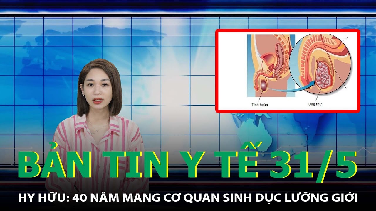 Bản Tin Y Tế 31/5: Hy Hữu: 40 Năm Mang Cơ Quan Sinh Dục Lưỡng Giới |SKĐS