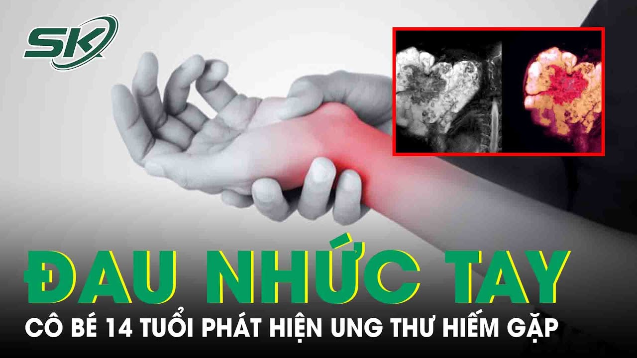 Cô Bé 14 Tuổi Phát Hiện Ung Thư Hiếm Gặp Từ Dấu Hiệu Đau Nhức Tay Trái |SKĐS