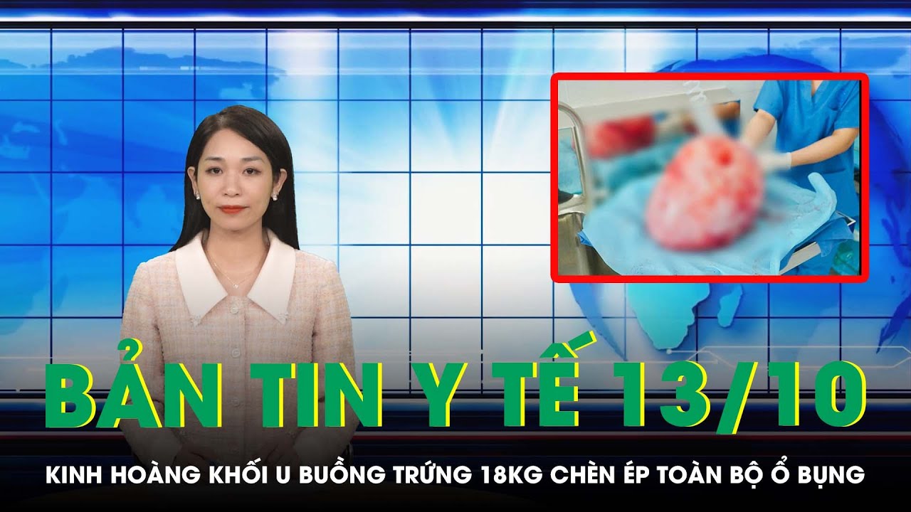 Bản Tin Y Tế 13/10: Kinh Hoàng Khối U Buồng Trứng 18kg Chèn Ép Toàn Bộ Ổ Bụng | SKĐS