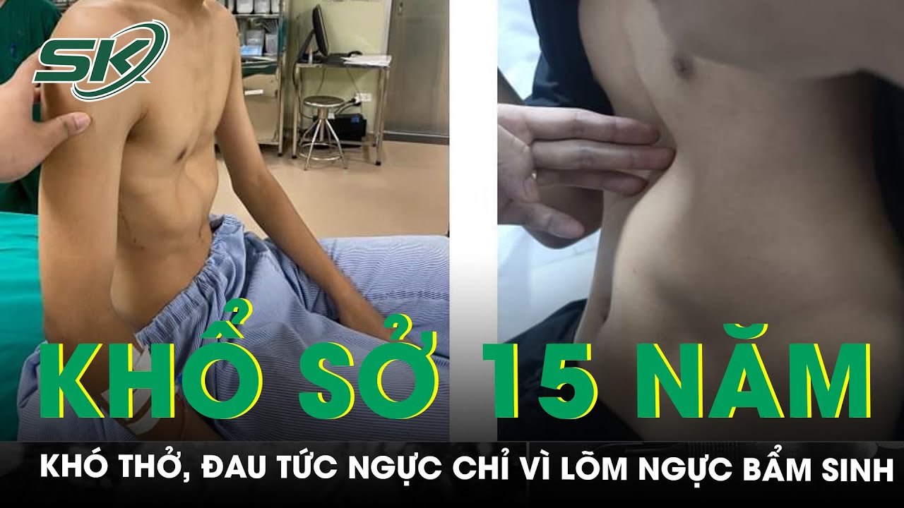 Bé Trai Khổ Sở Vì Đau Tức Ngực, Cong Vẹo Cột Sống Vì Lõm Ngực Bẩm Sinh | SKĐS