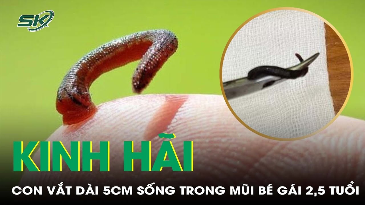 Gắp ra con vắt dài 5cm trong mũi bé gái sau nửa tháng đi chơi thác | SKĐS