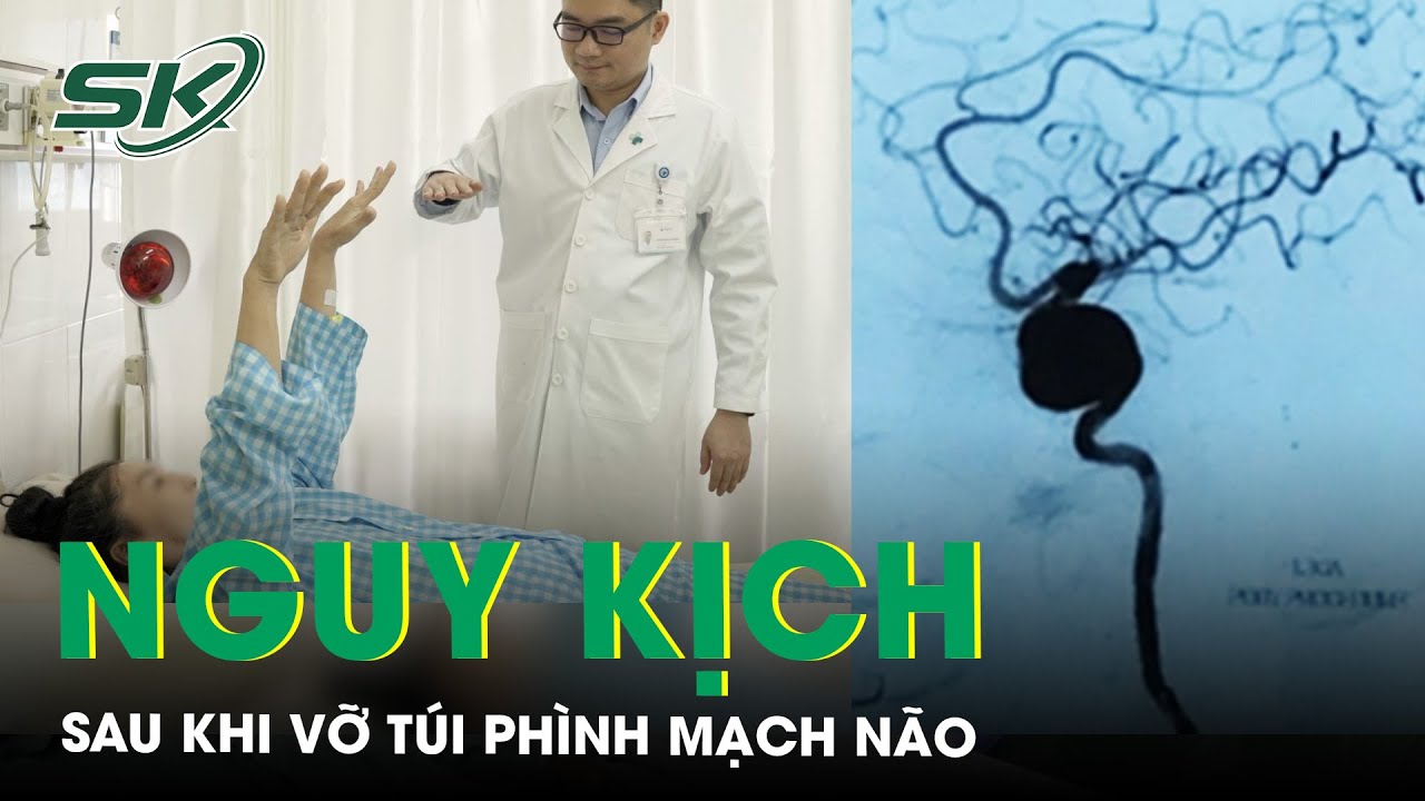 Đau Đầu Dữ Dội Nữ Bệnh Nhân Nguy Kịch Vì Vỡ Túi Phình Mạch Não | SKĐS