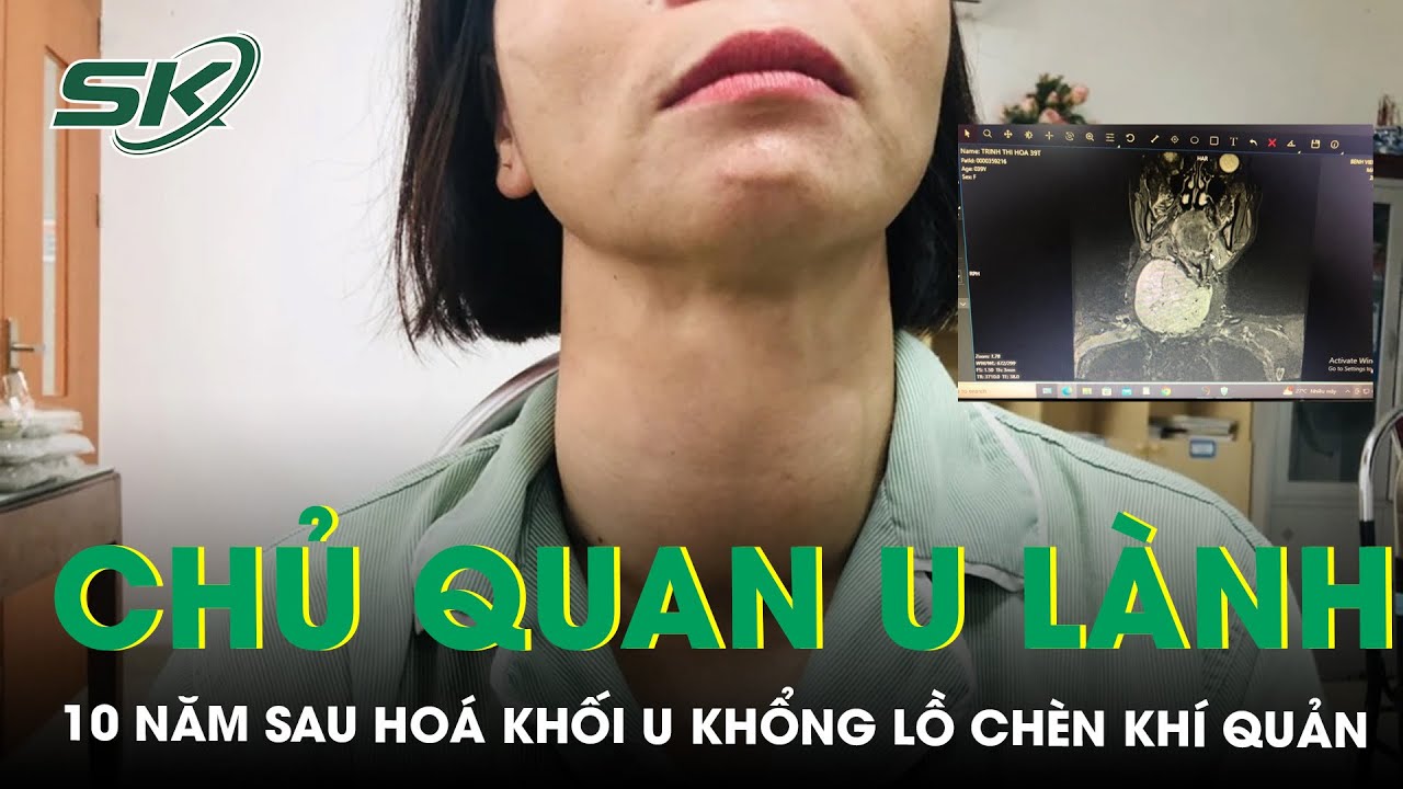 Chủ Quan Với Khối U Giáp Lành Tính, 10 Năm Sau Khối U Hoá Khổng Lồ Chèn Ép Khí Quản | SKĐS