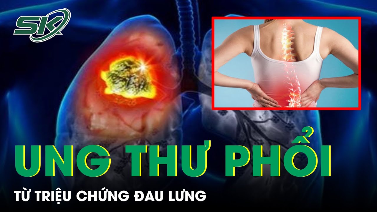 Phát Hiện Ung Thư Phổi Di Căn Từ Triệu Chứng Đau Lưng | SKĐS