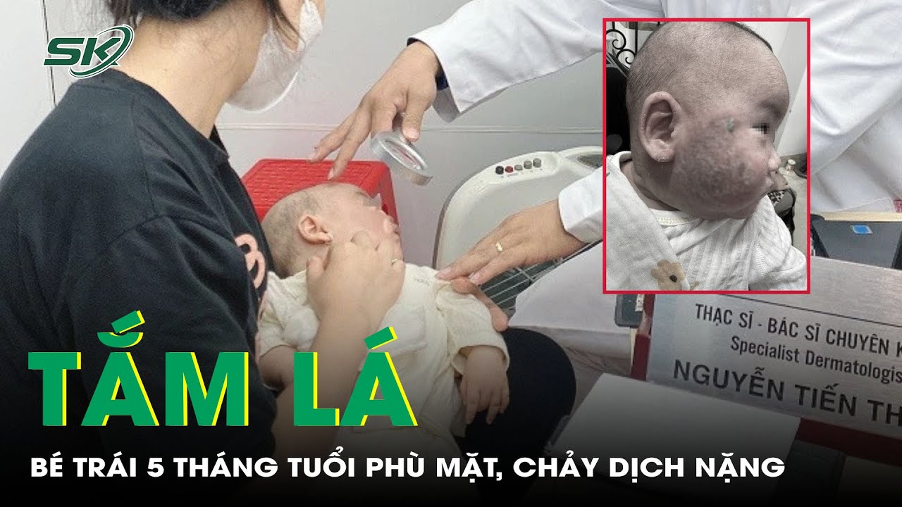 Tắm Lá, Bé Trai 5 Tháng Tuổi Phù Mặt, Chảy Dịch Nặng | SKĐS