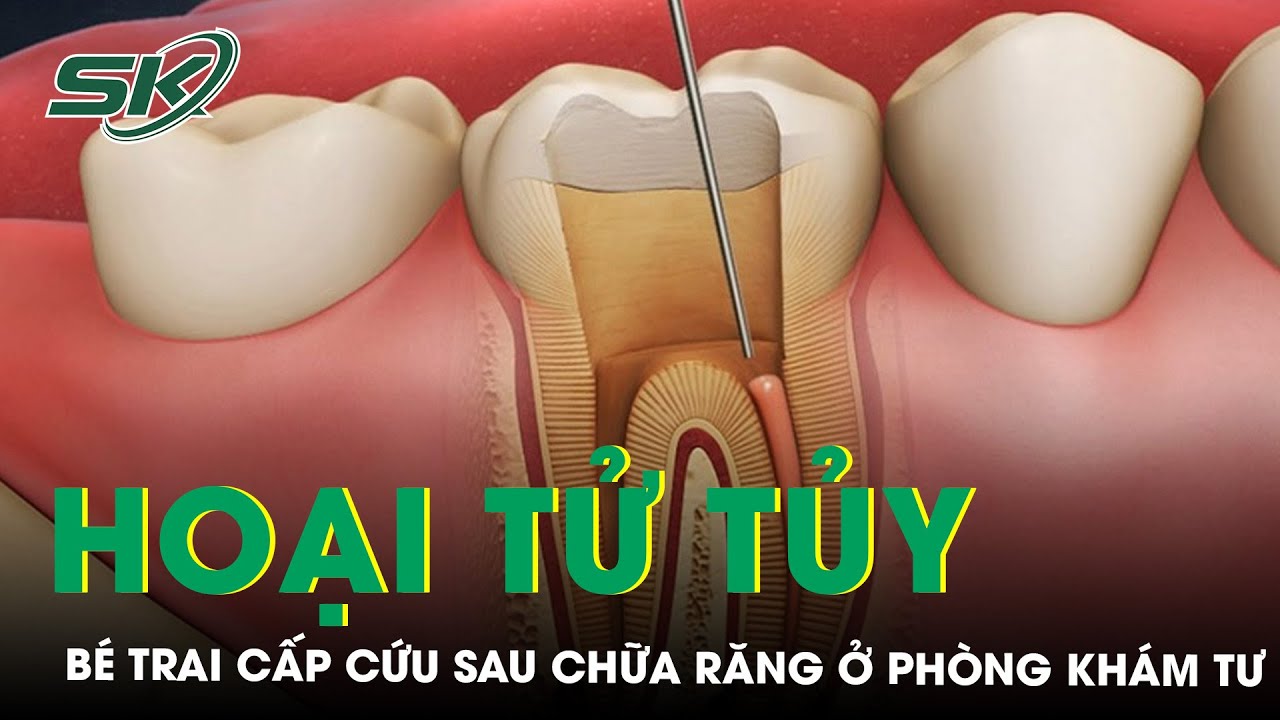 Chữa Răng Tại Phòng Khám Tư, Mặt Bé Trai Sưng Nề Hoại Tử Tủy | SKĐS