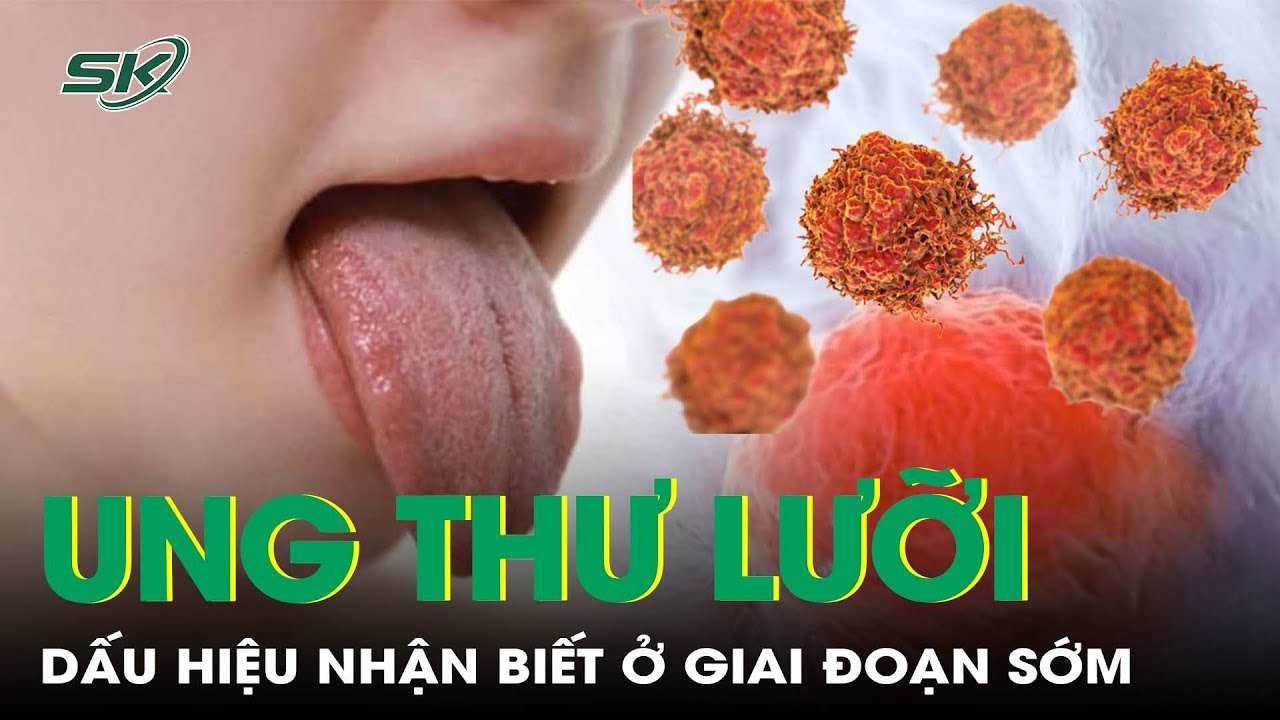 Dấu hiệu nhận biết sớm của ung thư lưỡi | SKĐS