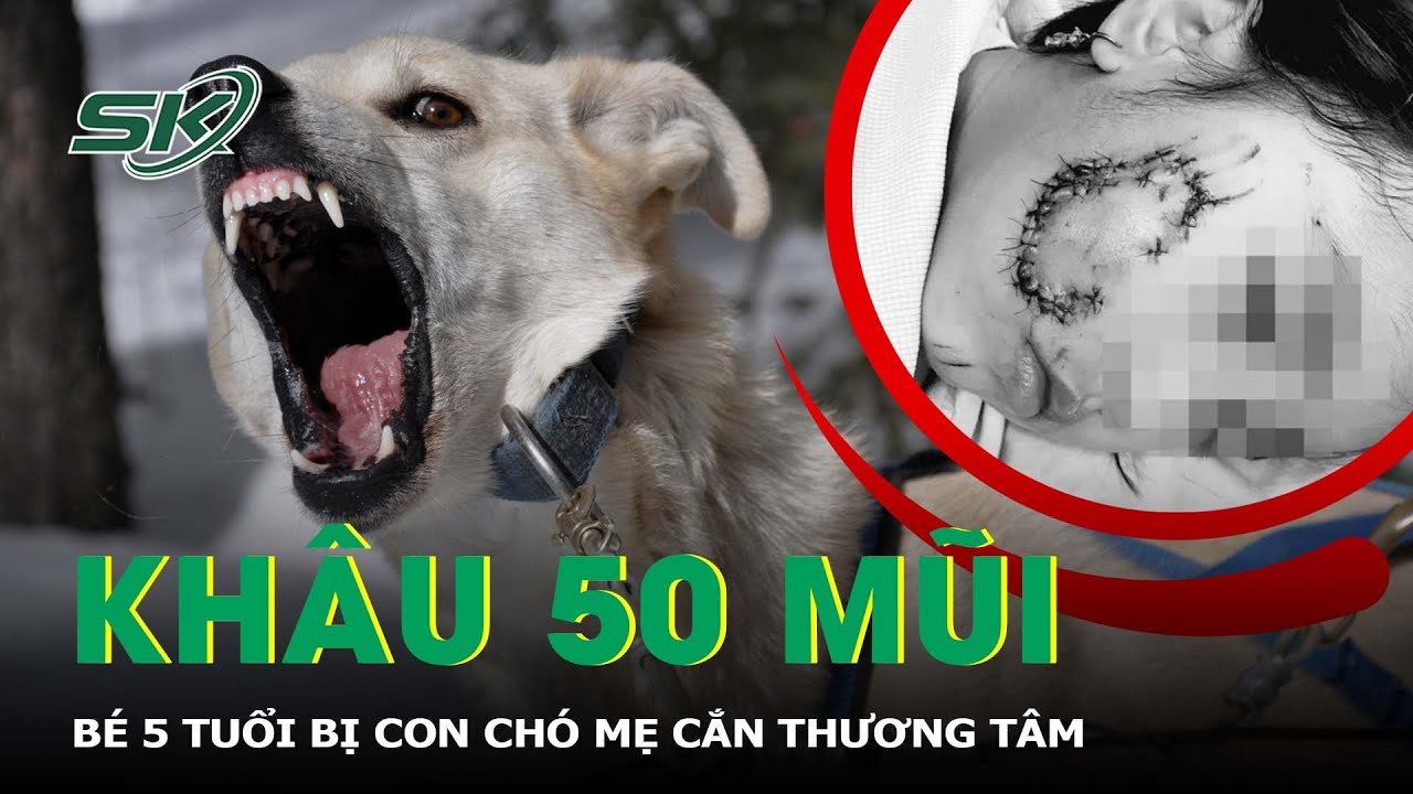 Bé 5 Tuổi Bị Chó Cắn Phải Khâu Gần 50 Mũi Ở Mặt | SKĐS