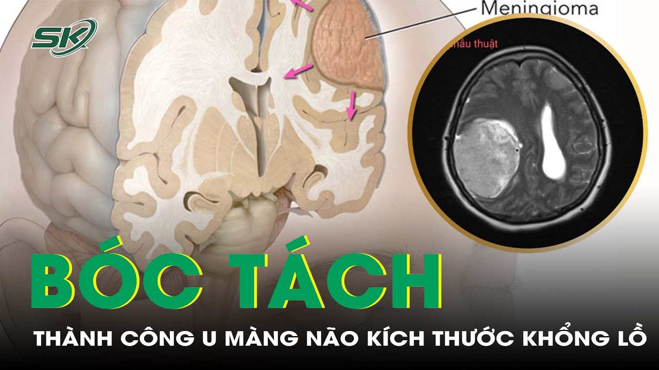 5 Giờ Căng Thẳng, Bóc Tách Thành Công Khối U Màng Não Kích Thước Khổng Lồ I SKĐS