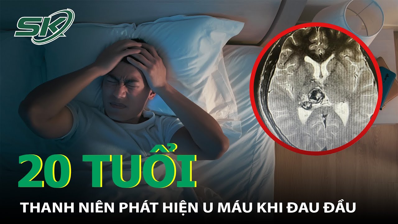 Đau Đầu, Chóng Mặt, Đi Khám Nam Thanh Niên Phát Hiện Khối U Máu Tại Não I SKĐS